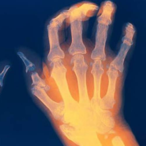 Homoeopathic Treatment for Rheumatoid Arthritis