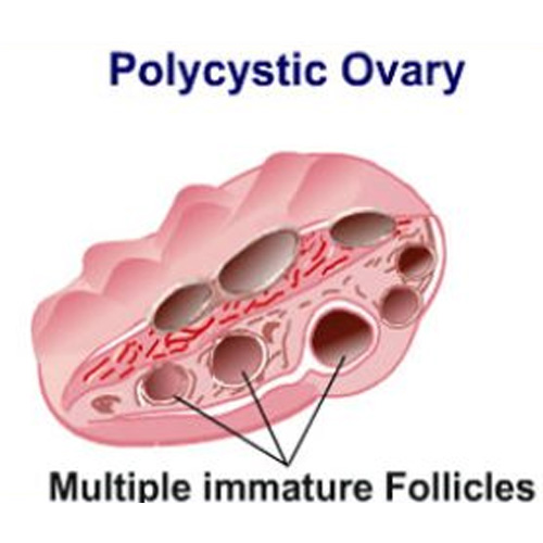 Homoeopathic Treatment for Polycystic Ovary 