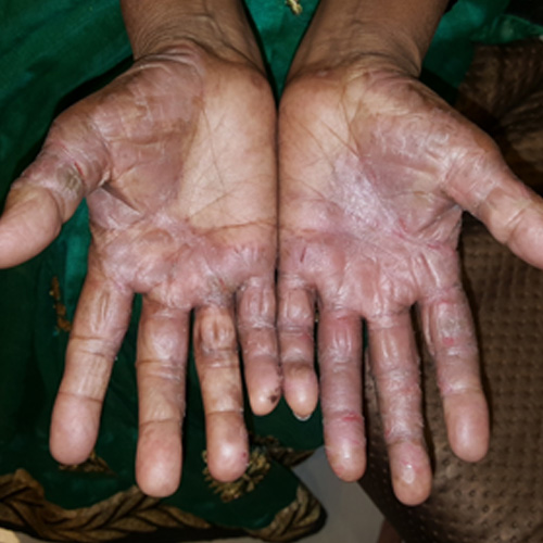 Homoeopathic Treatment for Palmoplantar Psoriasis 