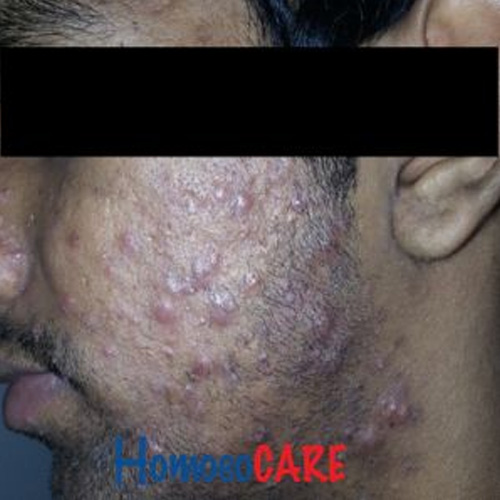 Homoeopathic Treatment for Pimples and Acne 