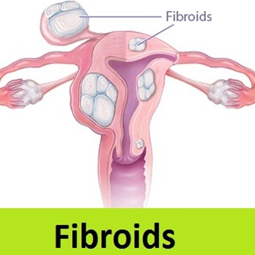 Homoeopathic Treatment for Fibroids