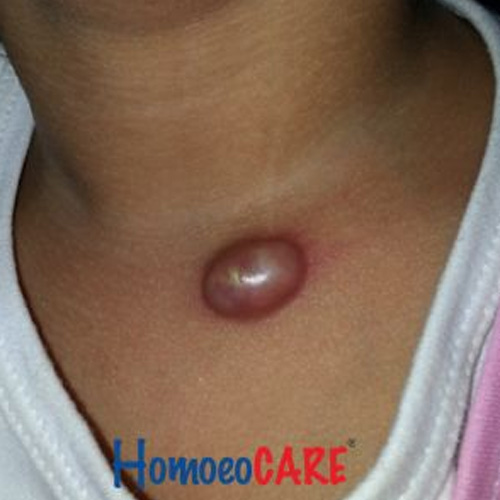 Homoeopathic Treatment for Brachial Cyst