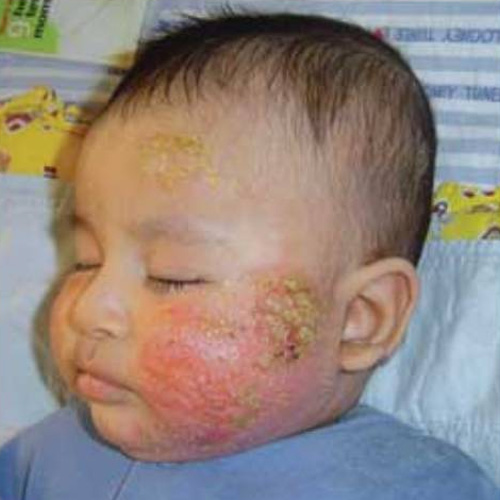 Homoeopathic Treatment for Atopic Dermatitis