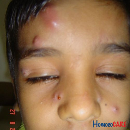 Homoeopathic Treatment for Recurrent Abscess 