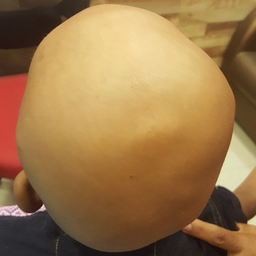Homoeopathic Treatment for  Alopecia Totalis