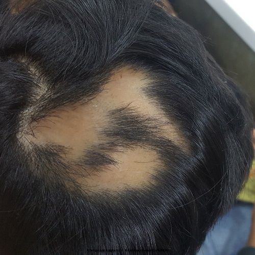 Homoeopathic Treatment for Alopecia Areata 