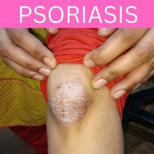 Homeopathic treatment of Psoriasis at Bhandup