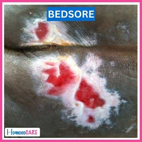 Homoeopathic Treatment for Bedsores