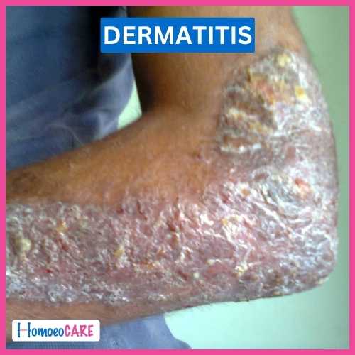 Homoeopathic Treatment for Infective Dermatits 
