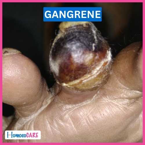 Homoeopathic Treatment for Gangrene