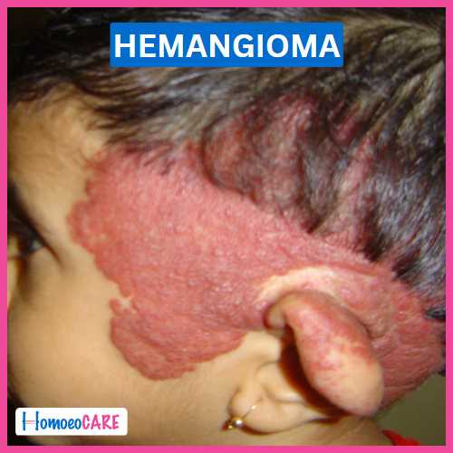 Homoeopathic Treatment for Hemangioma