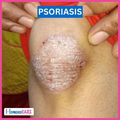 Homeopathy treatment of Psoriasis at Bhandup