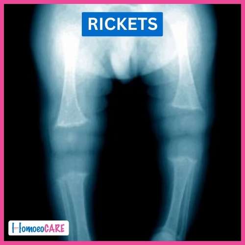 Homoeopathic Treatment for Rickets