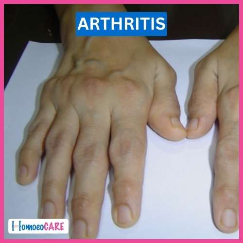 Homoeopathic Treatment for Arthritis