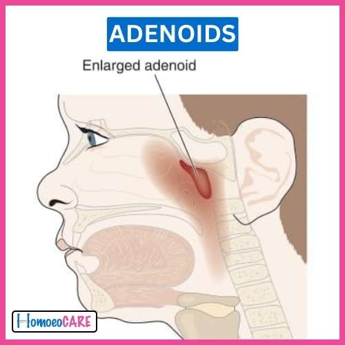 Homoeopathic Treatment for Adenoids