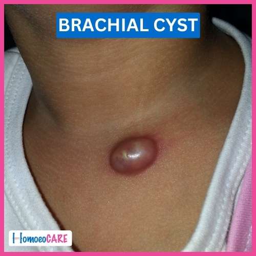 Homoeopathic Treatment for Brachial Cyst