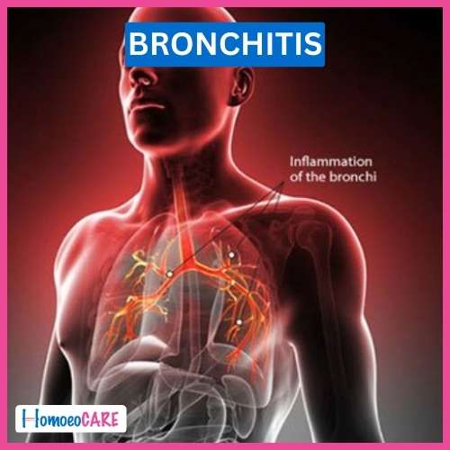 Homoeopathic Treatment for Bronchitis 
