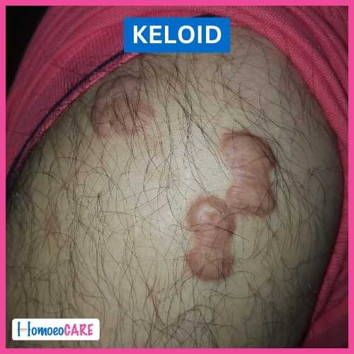 Homoeopathic Treatment for Keloid