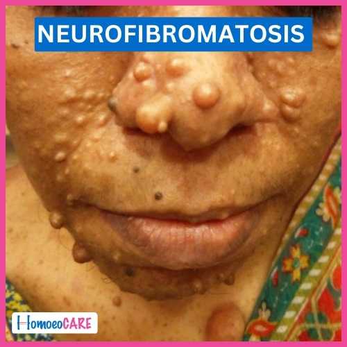 Homoeopathic Treatment for Neurofibromatosis