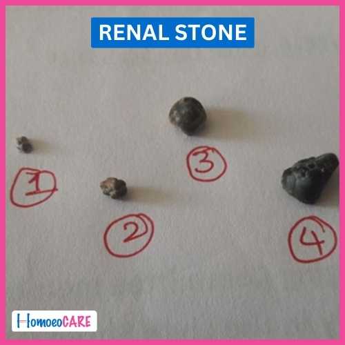 Homoeopathic Treatment for Renal stone