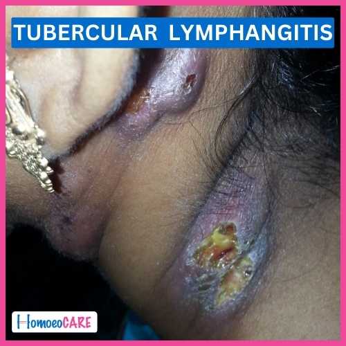 Homoeopathic Treatment for Tubercular Lymphangitis
