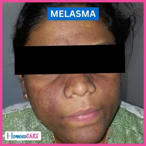 Homoeopathic Treatment for Melasma