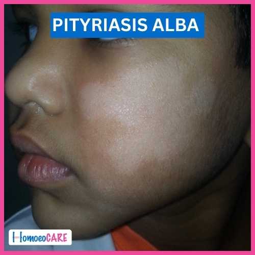 Homoeopathic Treatment for Pityriasis Alba
