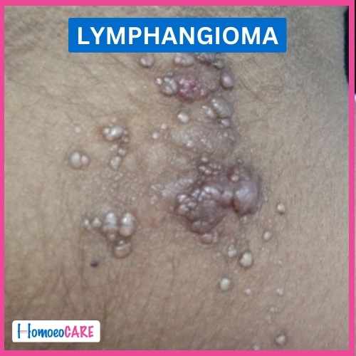 Homoeopathic Treatment for Lymphangioma 