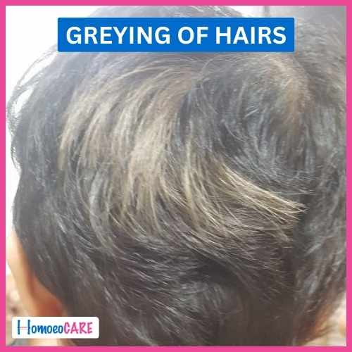Homoeopathic Treatment for Greying of hairs