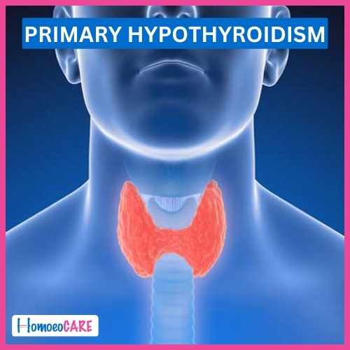 Homoeopathic Treatment for Primary Hypothyroidism 