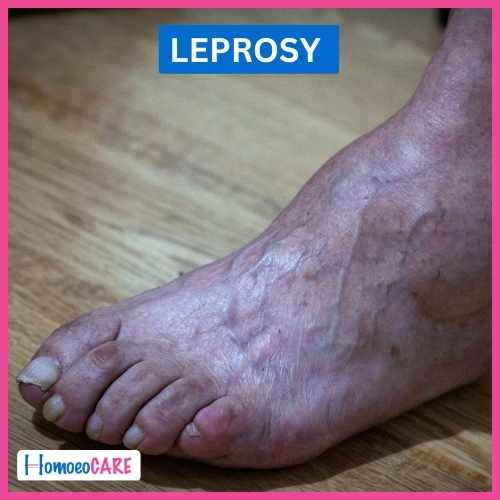 Homoeopathic treatment for Leprosy