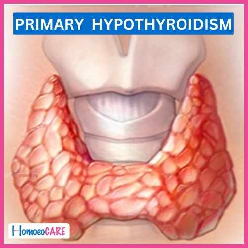 Homoeopathic Treatment for Primary Hypothyroidism 