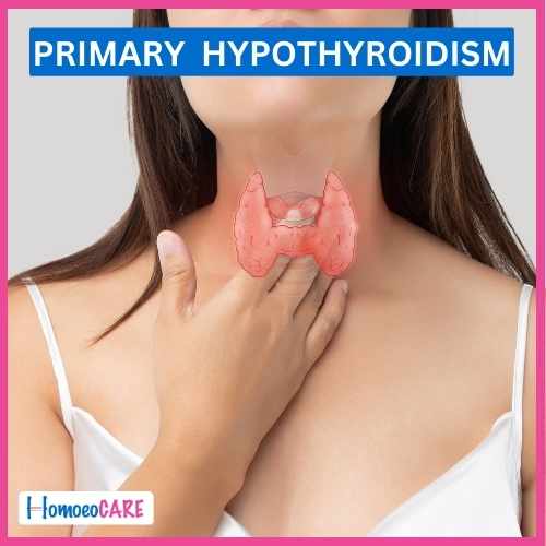 Homoeopathic Treatment for Hyperthyroidism
