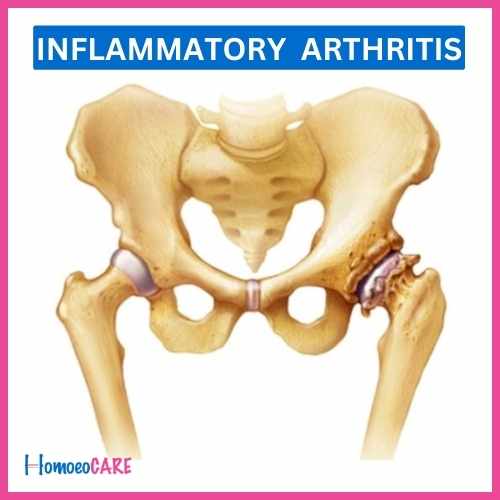 Homoeopathic Treatment for Inflammatory Arthritis