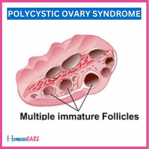 Homoeopathic Treatment for Polycystic Ovary 