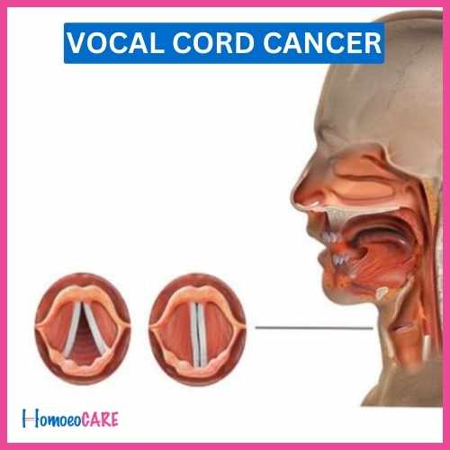 Homoeopathic Treatment for Vocal cord cancer