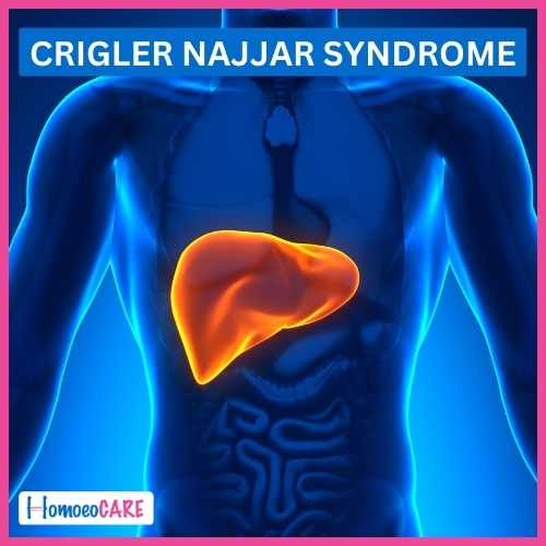 Homoeopathic Treatment for Crigler Najjar syndrome