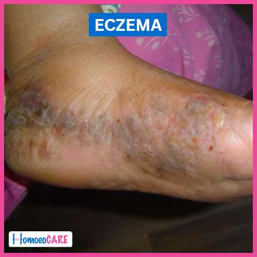 eczema foot treatment