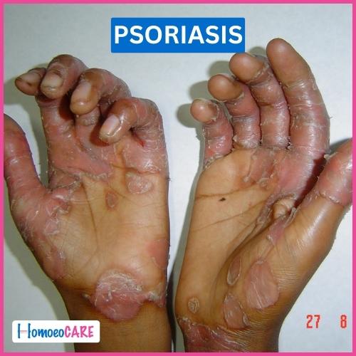 homeopathic treatment of psoriasis