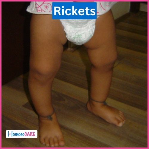 homeopathic treatment For Rickets