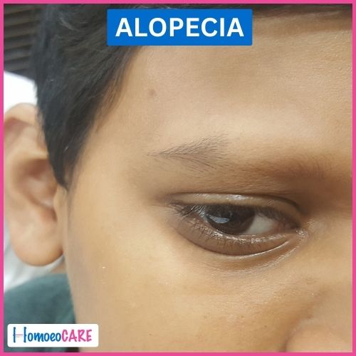 Homoeopathy Treatment for Alopecia Totalis