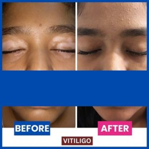 homeopathic treatment of  vitiligo