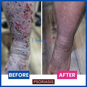 homeopathic treatment for infected psoriasis