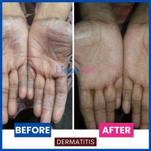homeopathic treatment for Contact dermatitis