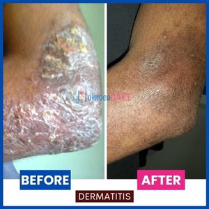 Atopic dermatitis homeopathic treatment