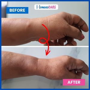 ganglion homeopathic treatment