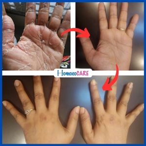 palmar psoriasis homeopathic treatment