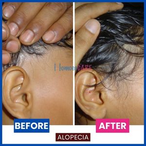 alopecia homeopathic treatment