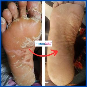 plantar psoriasis homeopathic treatment