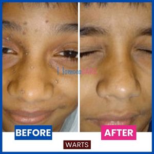 warts homeopathic treatment